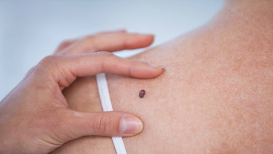 Why it would be a mistake to dismiss non-melanoma cancer