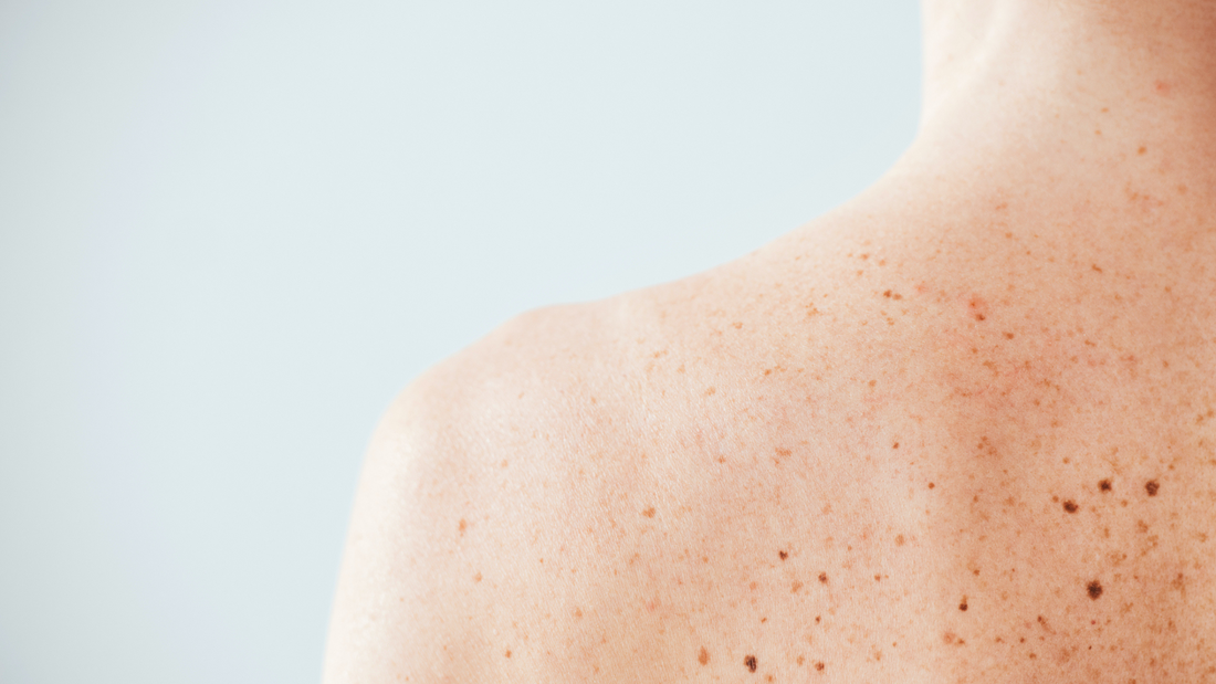 Solbari blog: How many moles is deemed a high risk of skin cancer or melanoma?