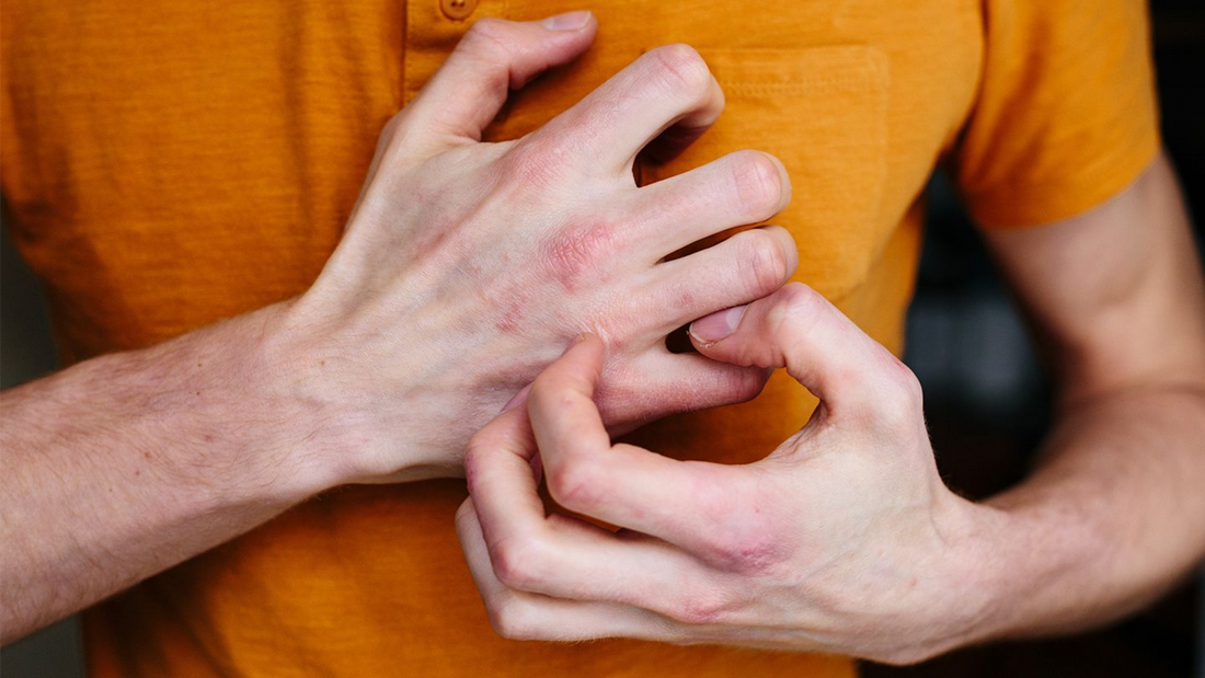 Solbari blog: What is eczema?