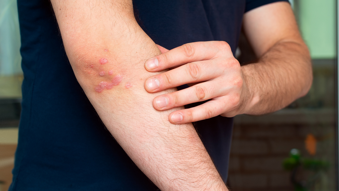 Do you suffer from plaque psoriasis? Have you considered participating in a research trial?