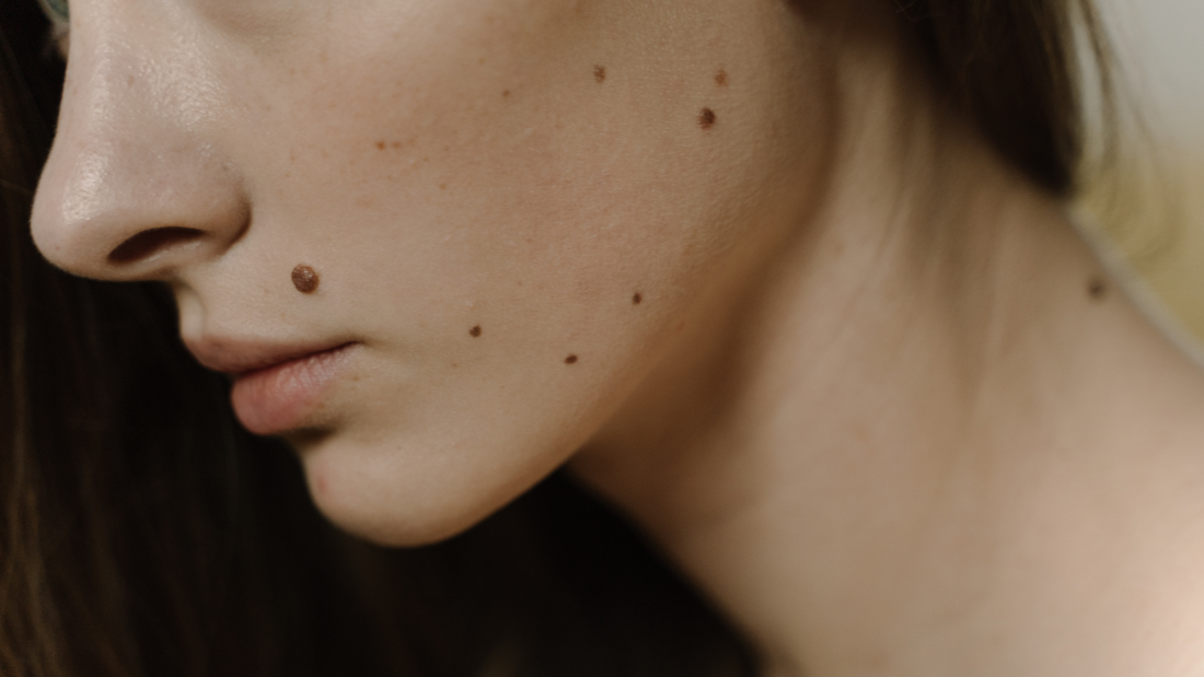 Solbari blog: How do I know if a mole is cancerous?