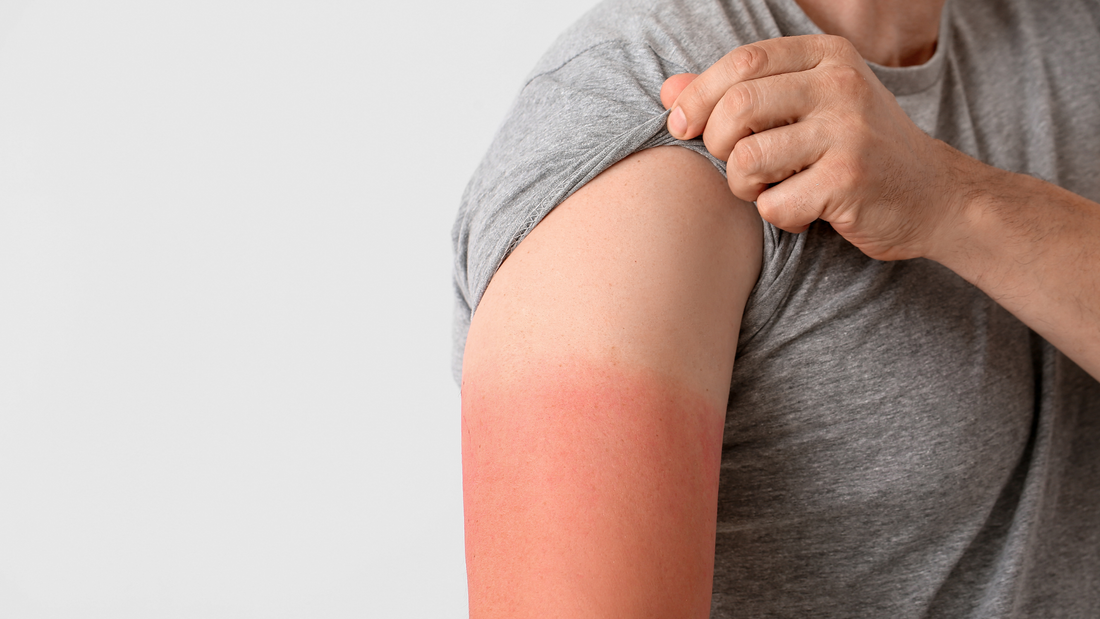 Solbar blog: How many sunburns does it take to get skin cancer?