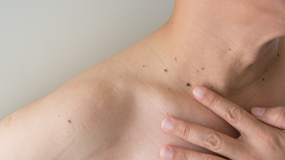 Solbari blog: What’s the difference between a benign and a malignant mole?