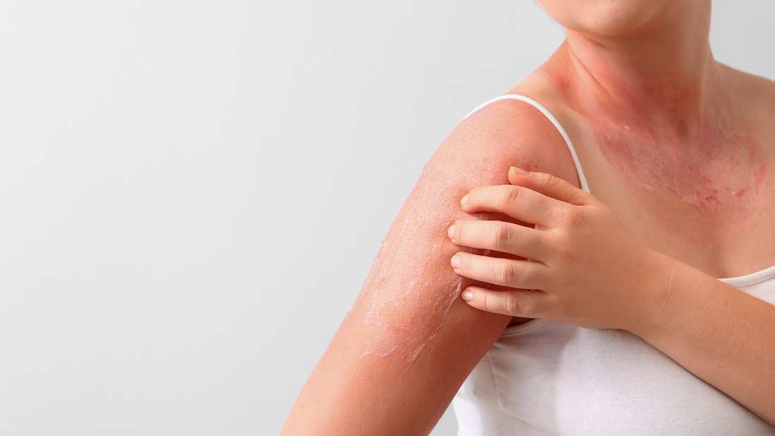 Why does skin peel after sun burn?